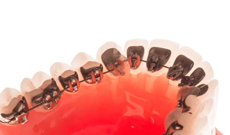 aparat dentar incognito