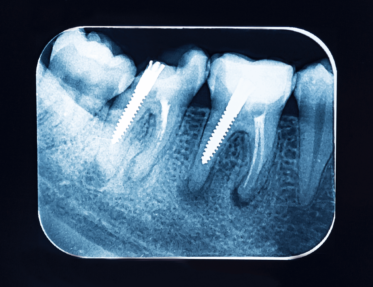 did it Mysterious hard Pivot dentar - Importanta unui pivot dentar | Green Dental