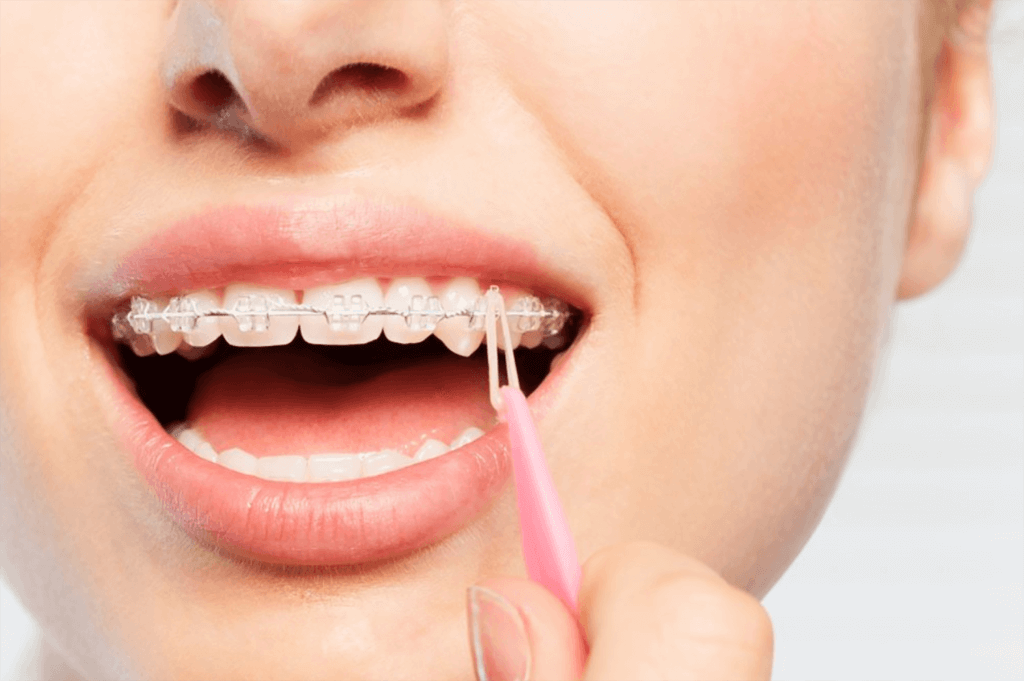 elastice aparat dentar