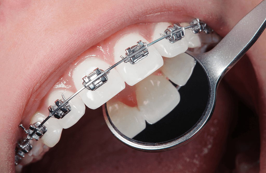 garbage anything Suffix Aparat dentar metalic - Ce implica tratamentul cu aparat dentar metalic